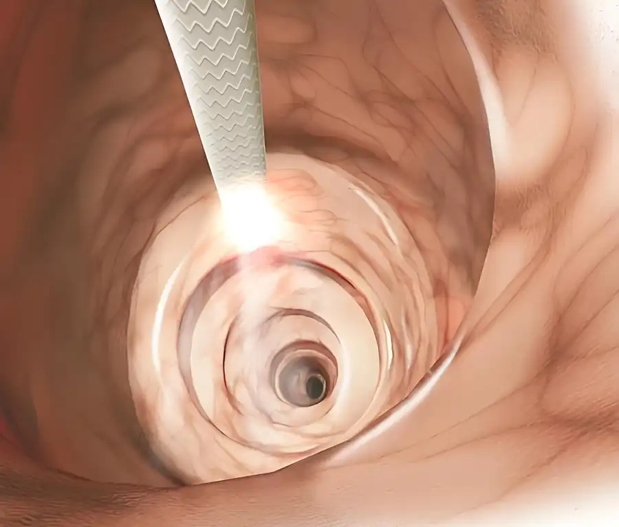 Colonoscopy