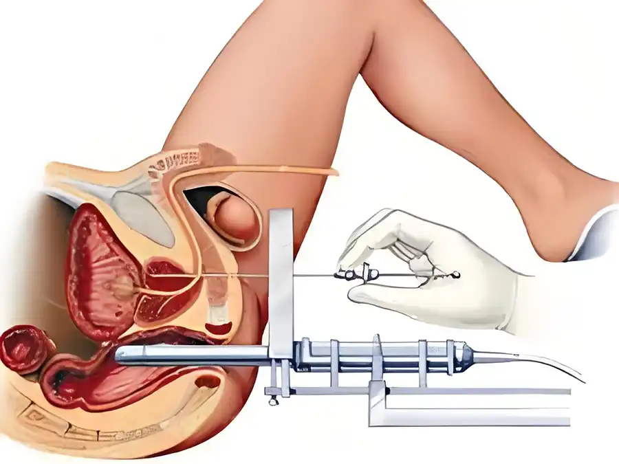 Cystoscopy