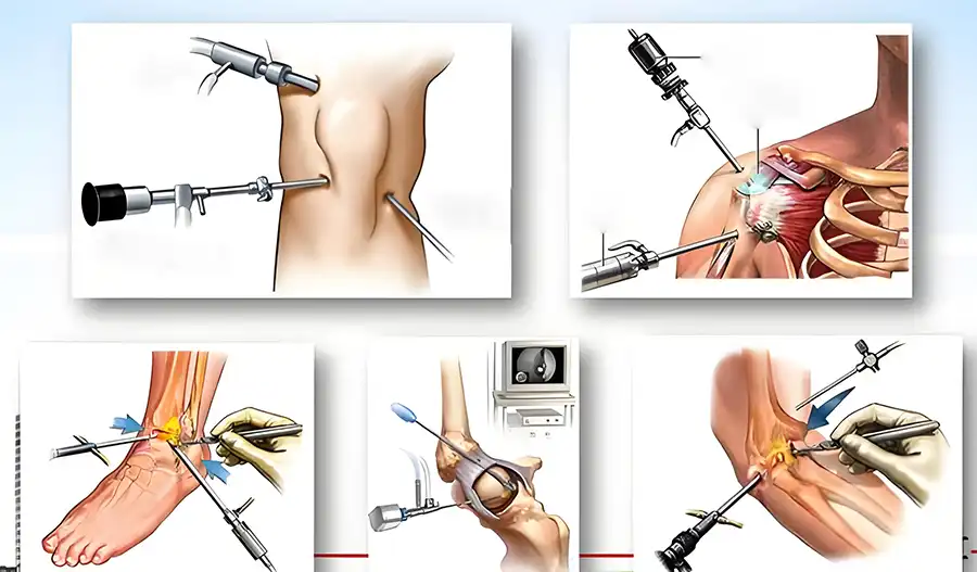 Arthroscopy