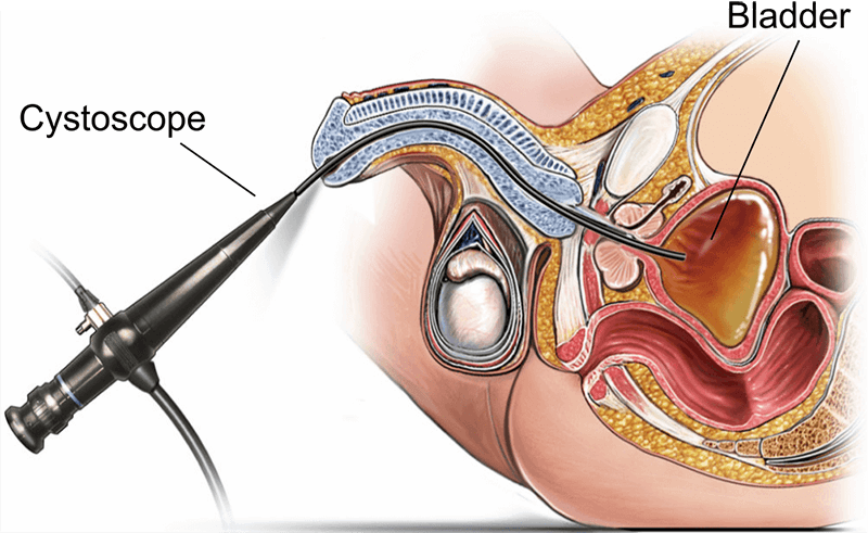 Cystoscope