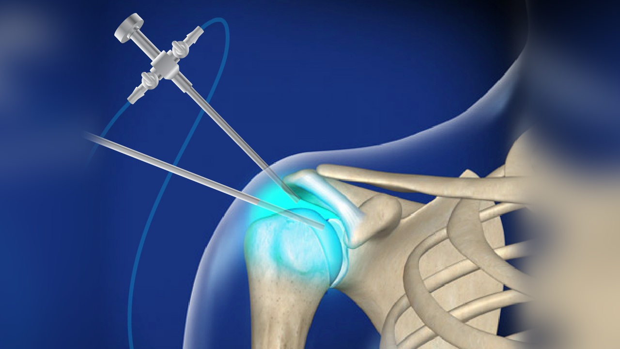 arthroscopy shoulder