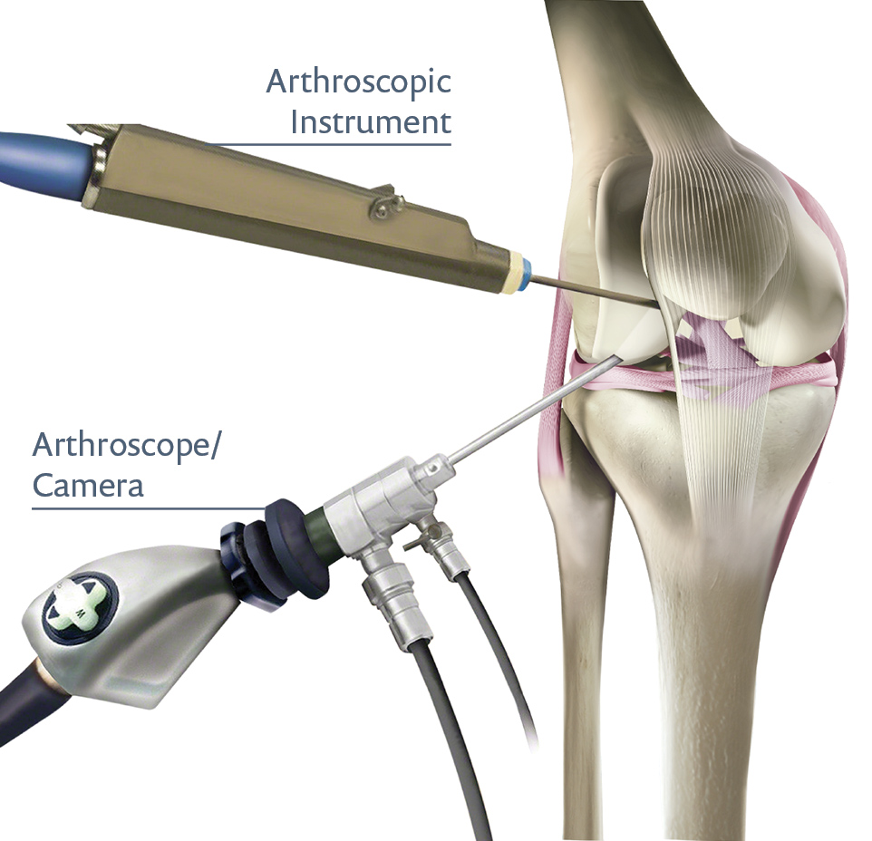 shoulder surgery arthroscopy