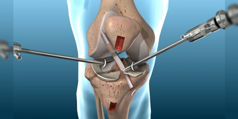 arthroscopy of the knee joint