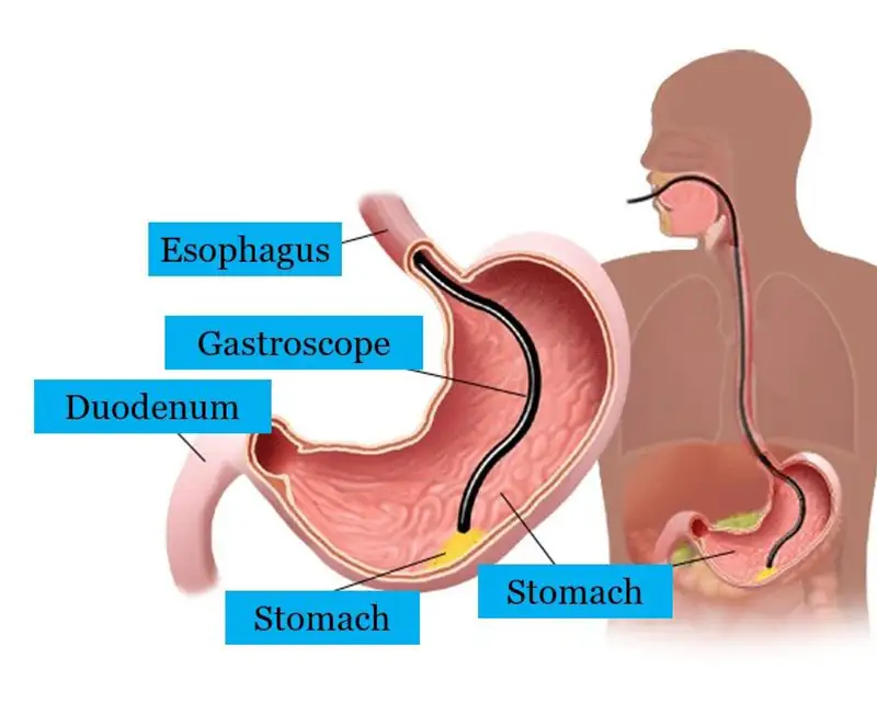 gastroscopy endoscopy