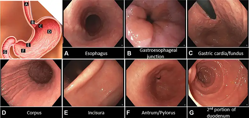 gastroscopy procedure