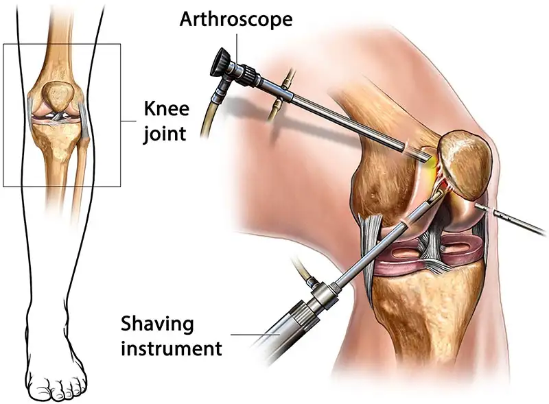 arthroscopy-illustration