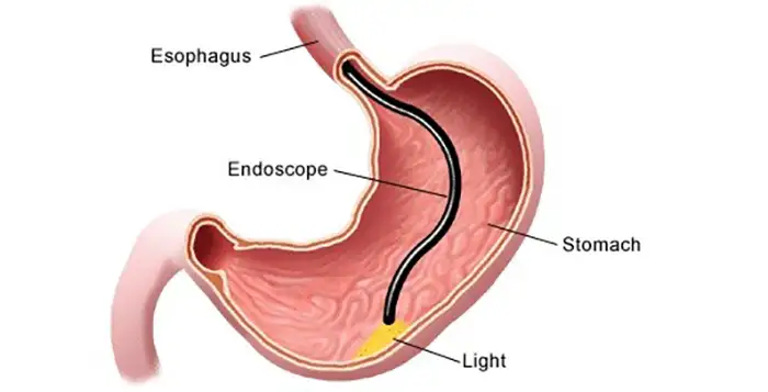 Endoscopy