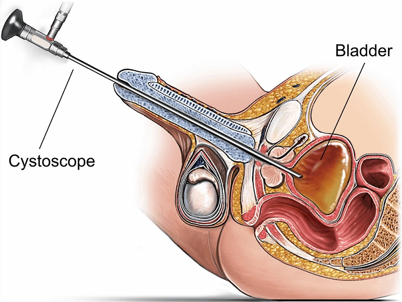 What is a cystoscope?